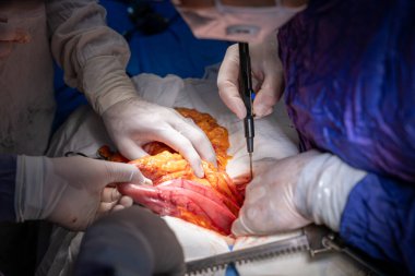 Hastane, cerrah, ameliyat, ameliyat, doktor, cerrahi, hasta, ilaç, kişi, hemşire, sağlık, takım çalışması, mide ameliyatı.