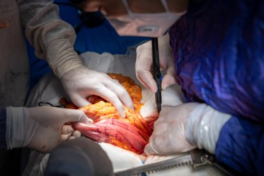 Hastane, cerrah, ameliyat, ameliyat, doktor, cerrahi, hasta, ilaç, kişi, hemşire, sağlık, takım çalışması, mide ameliyatı.