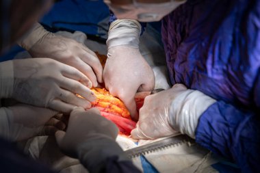 Hastane, cerrah, ameliyat, ameliyat, doktor, cerrahi, hasta, ilaç, kişi, hemşire, sağlık, takım çalışması, mide ameliyatı.