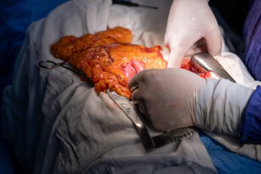 Hastane, cerrah, ameliyat, ameliyat, doktor, cerrahi, hasta, ilaç, kişi, hemşire, sağlık, takım çalışması, mide ameliyatı.