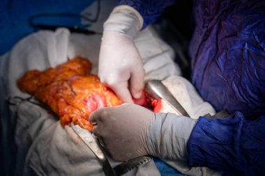 Hastane, cerrah, ameliyat, ameliyat, doktor, cerrahi, hasta, ilaç, kişi, hemşire, sağlık, takım çalışması, mide ameliyatı.