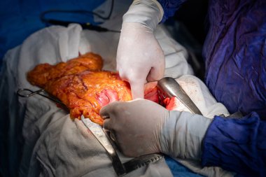 Hastane, cerrah, ameliyat, ameliyat, doktor, cerrahi, hasta, ilaç, kişi, hemşire, sağlık, takım çalışması, mide ameliyatı.