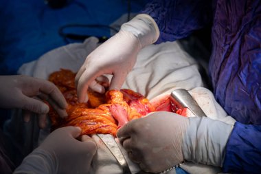 Hastane, cerrah, ameliyat, ameliyat, doktor, cerrahi, hasta, ilaç, kişi, hemşire, sağlık, takım çalışması, mide ameliyatı.