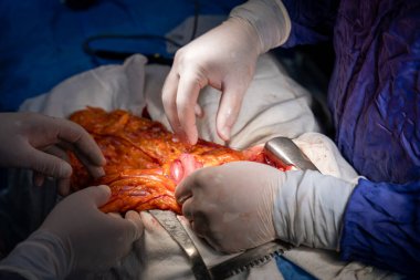 Hastane, cerrah, ameliyat, ameliyat, doktor, cerrahi, hasta, ilaç, kişi, hemşire, sağlık, takım çalışması, mide ameliyatı.