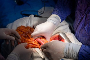 Hastane, cerrah, ameliyat, ameliyat, doktor, cerrahi, hasta, ilaç, kişi, hemşire, sağlık, takım çalışması, mide ameliyatı.