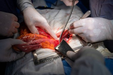 Hastane, cerrah, ameliyat, ameliyat, doktor, cerrahi, hasta, ilaç, kişi, hemşire, sağlık, takım çalışması, mide ameliyatı.