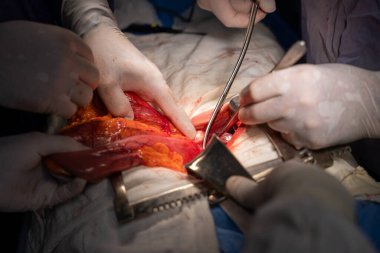 Hastane, cerrah, ameliyat, ameliyat, doktor, cerrahi, hasta, ilaç, kişi, hemşire, sağlık, takım çalışması, mide ameliyatı.