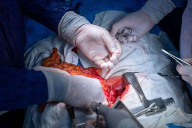 Hastane, cerrah, ameliyat, ameliyat, doktor, cerrahi, hasta, ilaç, kişi, hemşire, sağlık, takım çalışması, mide ameliyatı.