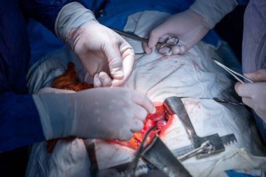 Hastane, cerrah, ameliyat, ameliyat, doktor, cerrahi, hasta, ilaç, kişi, hemşire, sağlık, takım çalışması, mide ameliyatı.