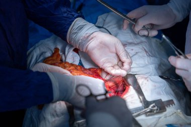 Hastane, cerrah, ameliyat, ameliyat, doktor, cerrahi, hasta, ilaç, kişi, hemşire, sağlık, takım çalışması, mide ameliyatı.