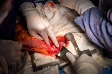 Hastane, cerrah, ameliyat, ameliyat, doktor, cerrahi, hasta, ilaç, kişi, hemşire, sağlık, takım çalışması, mide ameliyatı.