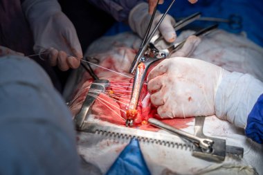 Hastane, cerrah, ameliyat, ameliyat, doktor, cerrahi, hasta, ilaç, kişi, hemşire, sağlık, takım çalışması, mide ameliyatı.