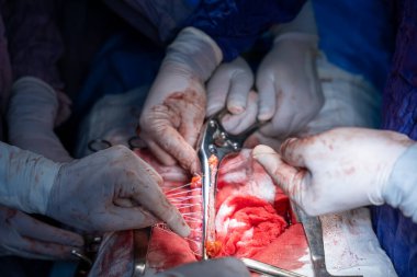 Hastane, cerrah, ameliyat, ameliyat, doktor, cerrahi, hasta, ilaç, kişi, hemşire, sağlık, takım çalışması, mide ameliyatı.