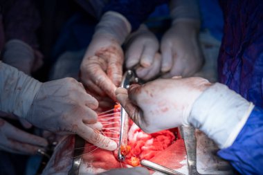 Hastane, cerrah, ameliyat, ameliyat, doktor, cerrahi, hasta, ilaç, kişi, hemşire, sağlık, takım çalışması, mide ameliyatı.