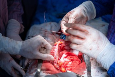 Hastane, cerrah, ameliyat, ameliyat, doktor, cerrahi, hasta, ilaç, kişi, hemşire, sağlık, takım çalışması, mide ameliyatı.