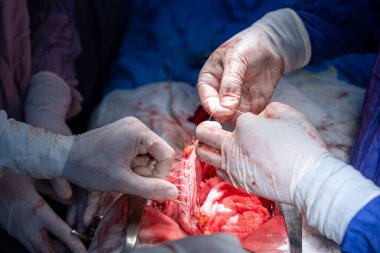 Hastane, cerrah, ameliyat, ameliyat, doktor, cerrahi, hasta, ilaç, kişi, hemşire, sağlık, takım çalışması, mide ameliyatı.