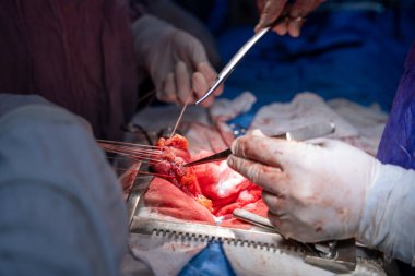 Hastane, cerrah, ameliyat, ameliyat, doktor, cerrahi, hasta, ilaç, kişi, hemşire, sağlık, takım çalışması, mide ameliyatı.