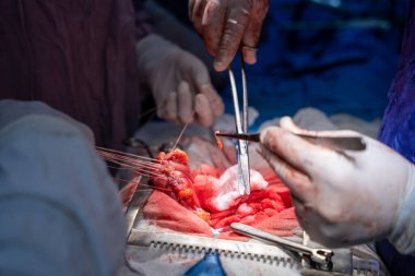 Hastane, cerrah, ameliyat, ameliyat, doktor, cerrahi, hasta, ilaç, kişi, hemşire, sağlık, takım çalışması, mide ameliyatı.