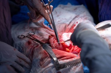 Hastane, cerrah, ameliyat, ameliyat, doktor, cerrahi, hasta, ilaç, kişi, hemşire, sağlık, takım çalışması, mide ameliyatı.