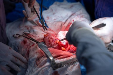 Hastane, cerrah, ameliyat, ameliyat, doktor, cerrahi, hasta, ilaç, kişi, hemşire, sağlık, takım çalışması, mide ameliyatı.