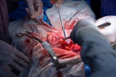 Hastane, cerrah, ameliyat, ameliyat, doktor, cerrahi, hasta, ilaç, kişi, hemşire, sağlık, takım çalışması, mide ameliyatı.