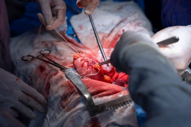 Hastane, cerrah, ameliyat, ameliyat, doktor, cerrahi, hasta, ilaç, kişi, hemşire, sağlık, takım çalışması, mide ameliyatı.