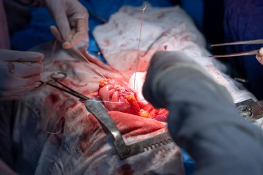 Hastane, cerrah, ameliyat, ameliyat, doktor, cerrahi, hasta, ilaç, kişi, hemşire, sağlık, takım çalışması, mide ameliyatı.