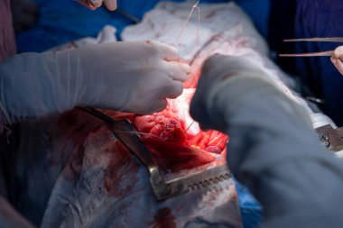 Hastane, cerrah, ameliyat, ameliyat, doktor, cerrahi, hasta, ilaç, kişi, hemşire, sağlık, takım çalışması, mide ameliyatı.