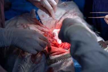 Hastane, cerrah, ameliyat, ameliyat, doktor, cerrahi, hasta, ilaç, kişi, hemşire, sağlık, takım çalışması, mide ameliyatı.