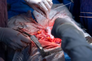 Hastane, cerrah, ameliyat, ameliyat, doktor, cerrahi, hasta, ilaç, kişi, hemşire, sağlık, takım çalışması, mide ameliyatı.