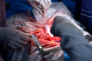 Hastane, cerrah, ameliyat, ameliyat, doktor, cerrahi, hasta, ilaç, kişi, hemşire, sağlık, takım çalışması, mide ameliyatı.