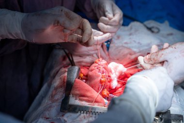 Hastane, cerrah, ameliyat, ameliyat, doktor, cerrahi, hasta, ilaç, kişi, hemşire, sağlık, takım çalışması, mide ameliyatı.