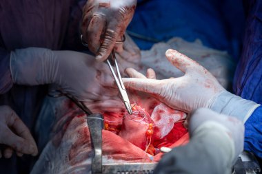 Hastane, cerrah, ameliyat, ameliyat, doktor, cerrahi, hasta, ilaç, kişi, hemşire, sağlık, takım çalışması, mide ameliyatı.