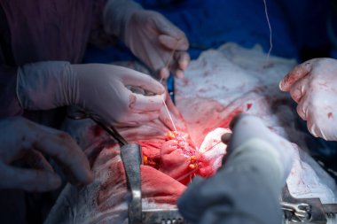 Hastane, cerrah, ameliyat, ameliyat, doktor, cerrahi, hasta, ilaç, kişi, hemşire, sağlık, takım çalışması, mide ameliyatı.