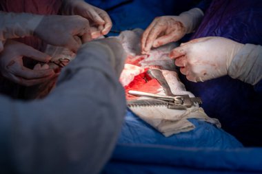 Hastane, cerrah, ameliyat, ameliyat, doktor, cerrahi, hasta, ilaç, kişi, hemşire, sağlık, takım çalışması, mide ameliyatı.