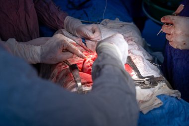 Hastane, cerrah, ameliyat, ameliyat, doktor, cerrahi, hasta, ilaç, kişi, hemşire, sağlık, takım çalışması, mide ameliyatı.