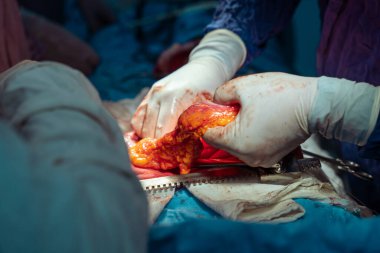 Hastane, cerrah, ameliyat, ameliyat, doktor, cerrahi, hasta, ilaç, kişi, hemşire, sağlık, takım çalışması, mide ameliyatı.