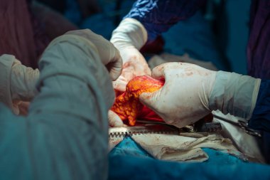 Hastane, cerrah, ameliyat, ameliyat, doktor, cerrahi, hasta, ilaç, kişi, hemşire, sağlık, takım çalışması, mide ameliyatı.