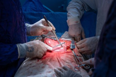 Hastane, cerrah, ameliyat, ameliyat, doktor, cerrahi, hasta, ilaç, kişi, hemşire, sağlık, takım çalışması, mide ameliyatı.