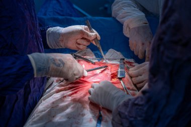 Hastane, cerrah, ameliyat, ameliyat, doktor, cerrahi, hasta, ilaç, kişi, hemşire, sağlık, takım çalışması, mide ameliyatı.