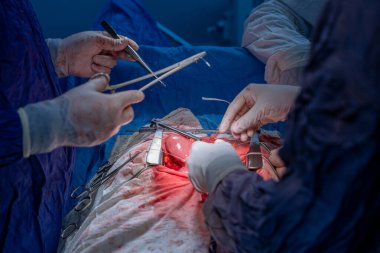 Hastane, cerrah, ameliyat, ameliyat, doktor, cerrahi, hasta, ilaç, kişi, hemşire, sağlık, takım çalışması, mide ameliyatı.