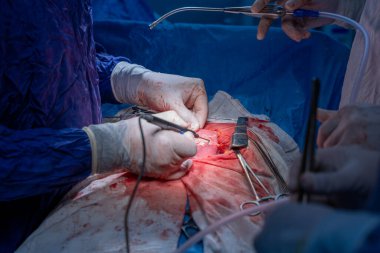 Hastane, cerrah, ameliyat, ameliyat, doktor, cerrahi, hasta, ilaç, kişi, hemşire, sağlık, takım çalışması, mide ameliyatı.