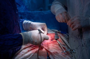 Hastane, cerrah, ameliyat, ameliyat, doktor, cerrahi, hasta, ilaç, kişi, hemşire, sağlık, takım çalışması, mide ameliyatı.