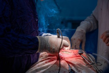 Hastane, cerrah, ameliyat, ameliyat, doktor, cerrahi, hasta, ilaç, kişi, hemşire, sağlık, takım çalışması, mide ameliyatı.