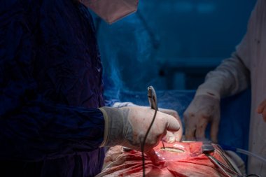 Hastane, cerrah, ameliyat, ameliyat, doktor, cerrahi, hasta, ilaç, kişi, hemşire, sağlık, takım çalışması, mide ameliyatı.