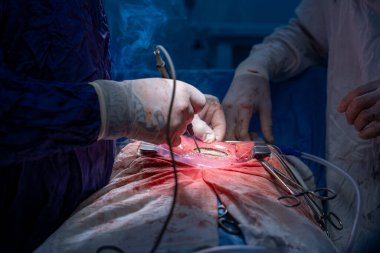 Hastane, cerrah, ameliyat, ameliyat, doktor, cerrahi, hasta, ilaç, kişi, hemşire, sağlık, takım çalışması, mide ameliyatı.