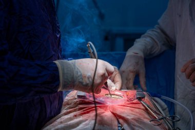 Hastane, cerrah, ameliyat, ameliyat, doktor, cerrahi, hasta, ilaç, kişi, hemşire, sağlık, takım çalışması, mide ameliyatı.