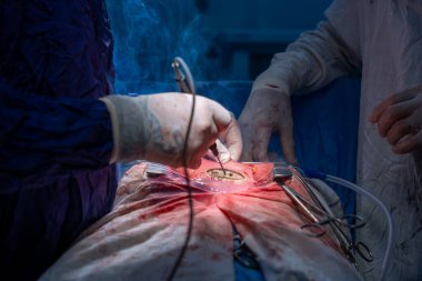 Hastane, cerrah, ameliyat, ameliyat, doktor, cerrahi, hasta, ilaç, kişi, hemşire, sağlık, takım çalışması, mide ameliyatı.