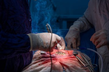 Hastane, cerrah, ameliyat, ameliyat, doktor, cerrahi, hasta, ilaç, kişi, hemşire, sağlık, takım çalışması, mide ameliyatı.