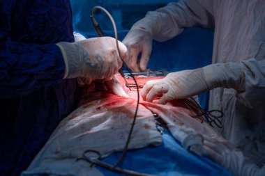 Hastane, cerrah, ameliyat, ameliyat, doktor, cerrahi, hasta, ilaç, kişi, hemşire, sağlık, takım çalışması, mide ameliyatı.